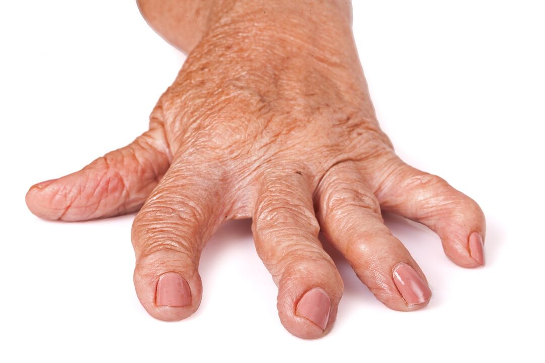 El medicamento HondroFrost para el dolor articular. 