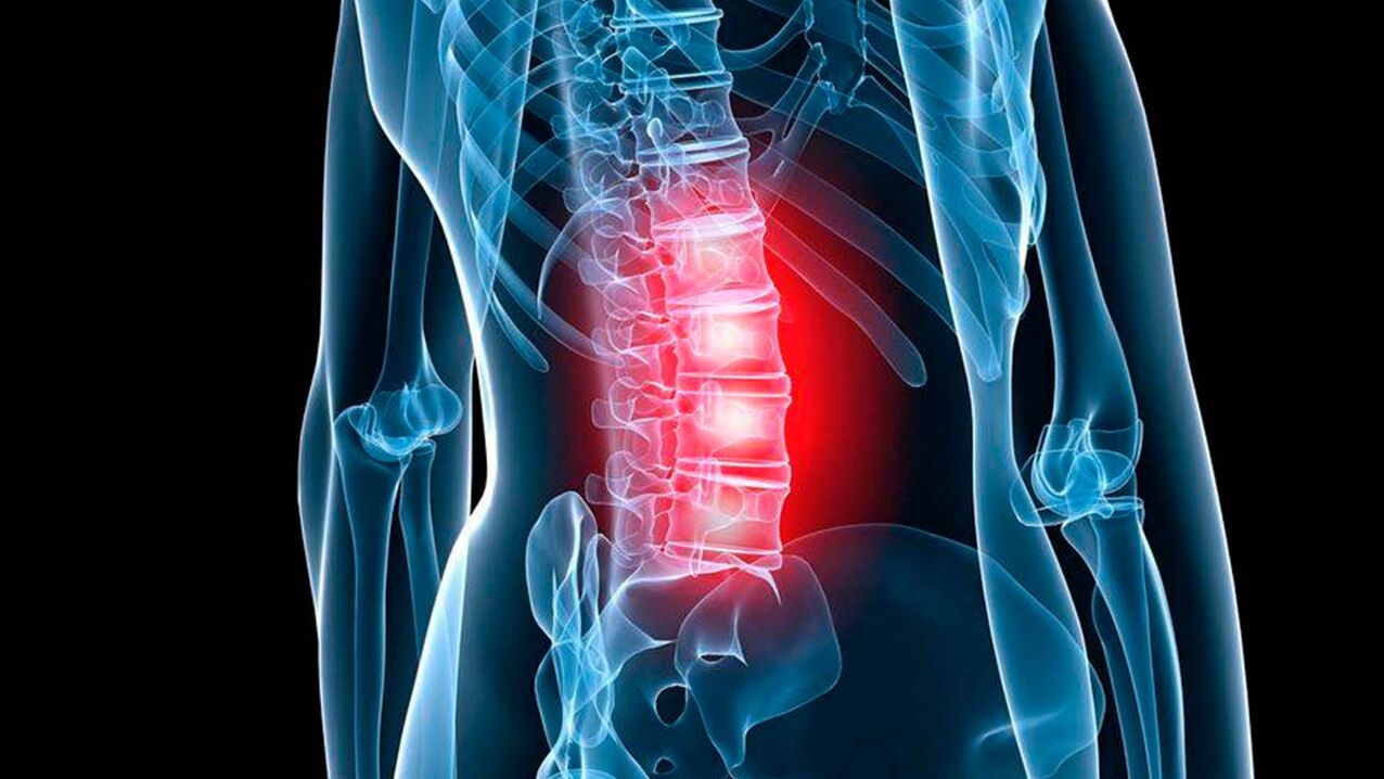 Síntomas de la osteocondrosis lumbar. 