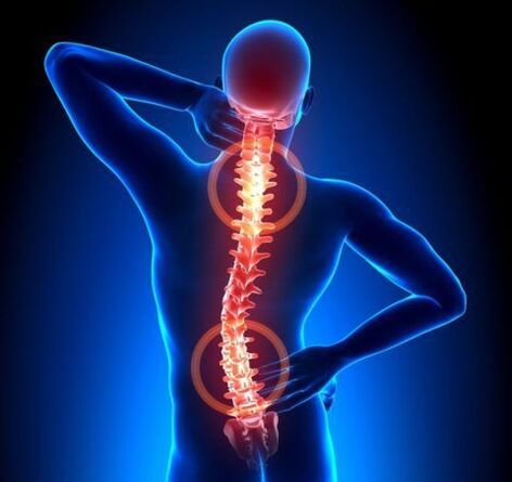 Osteocondrosis de la columna
