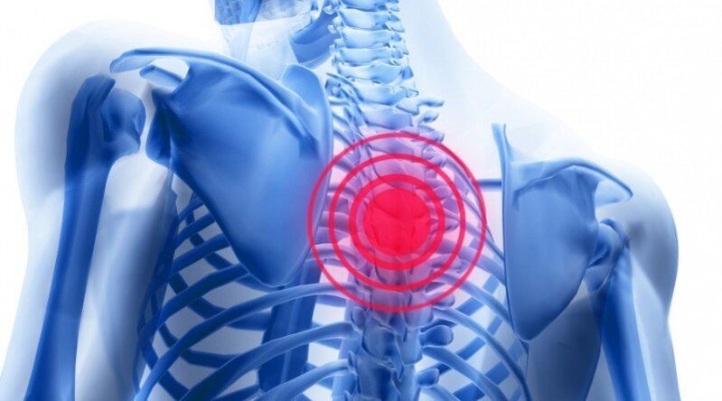 El dolor de espalda puede deberse a una hernia de disco.