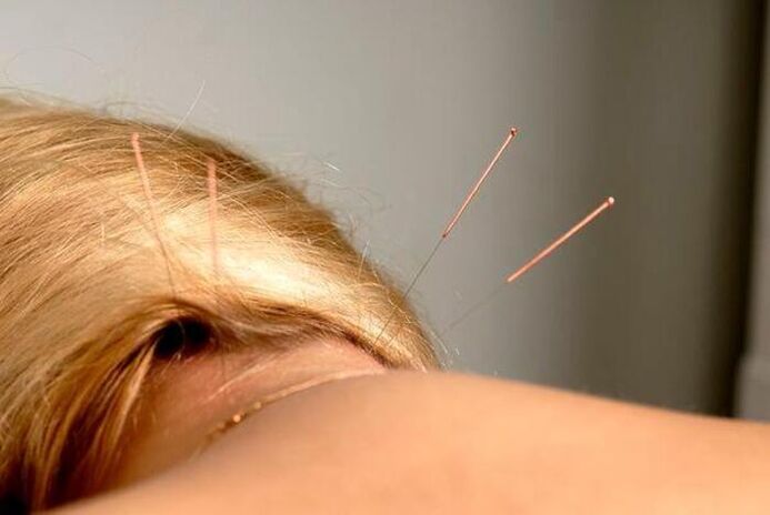 Acupuntura para la osteocondrosis.