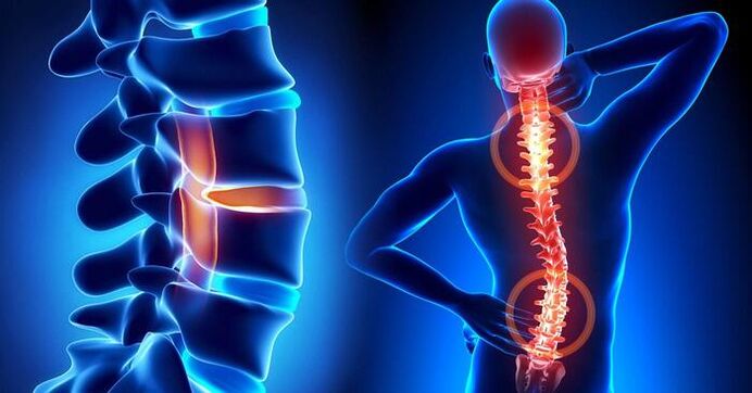 Localización del dolor en la osteocondrosis.