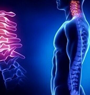 La osteocondrosis cervical puede ser causada por lesiones en el cuello.